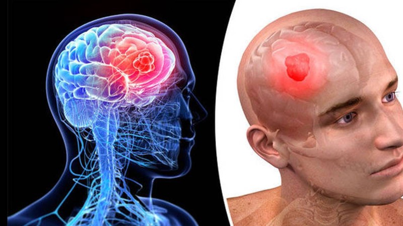Καρκίνος στον εγκέφαλο: Αν έχετε αυτά τα σημάδια τρέξτε αμέσως στον γιατρό!