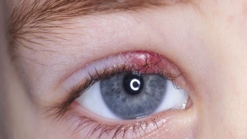 Κριθαράκι στο μάτι: Δείτε τι το προκαλεί και 5+1 φυσικές θεραπείες για να το καταπολεμήσετε