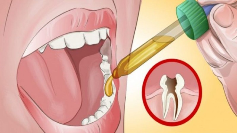 Έτσι θα απαλύνετε τον πονόδοντο με φυσικό τρόπο. Ακόμη και ο οδοντίατρός σας θα μείνει άφωνος με αυτή τη θαυματουργή συνταγή!