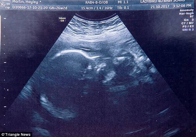 Έγκυος μητέρα ενημερώθηκε ότι το μωρό που κυοφορεί θα πεθάνει 