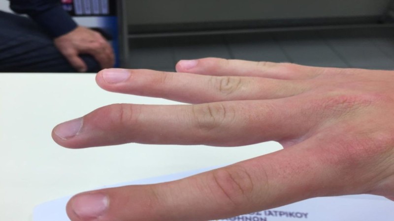 Καρκίνος: Τι δείχνουν τα δάχτυλα; 8+1 περίεργες “συνδέσεις” του σώματος