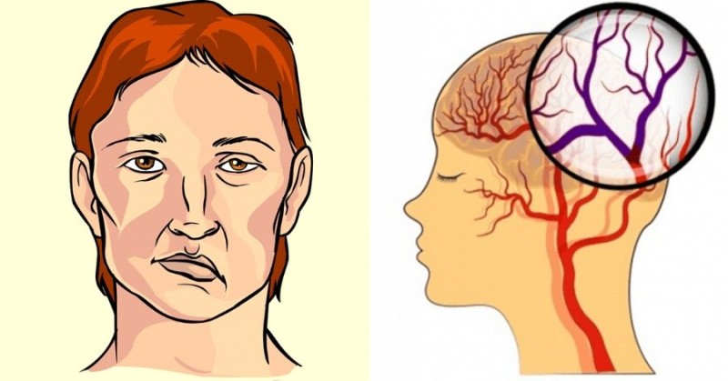 Εγκεφαλικό: Προσοχή στα πρώιμα συμπτώματα - Πώς μπορείτε να το προλάβετε