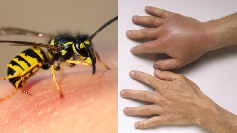 Τσίμπημα σφήκας ή μέλισσας: Τι πρέπει να κάνουμε άμεσα - Πώς φεύγει ο πόνος