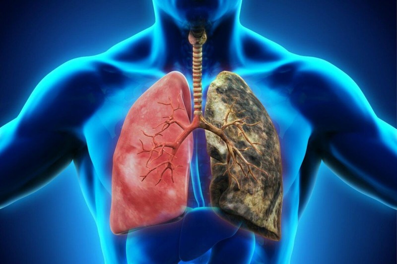 Καρκίνος του πνεύμονα και κάπνισμα