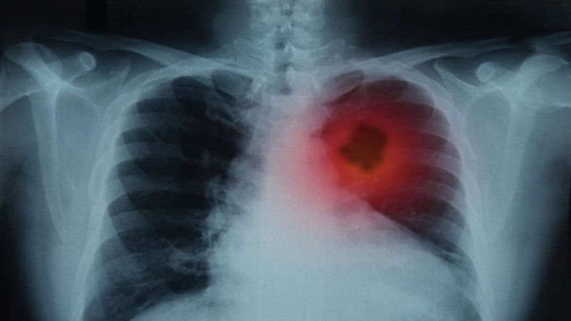 Καρκίνος του πνεύμονα: Τα σημάδια που πρέπει να δώσετε προσοχή - Τι μπορείτε να κάνετε προληπτικά