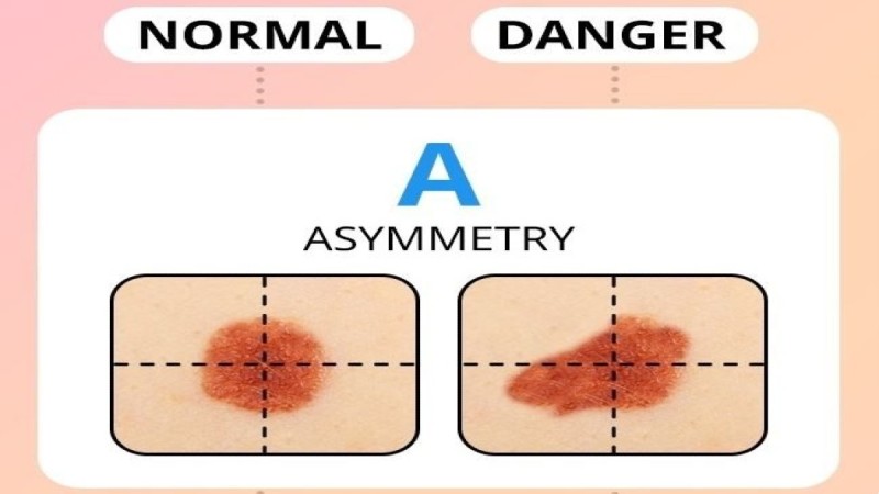 Σημάδι καρκίνου η ασυμμετρία