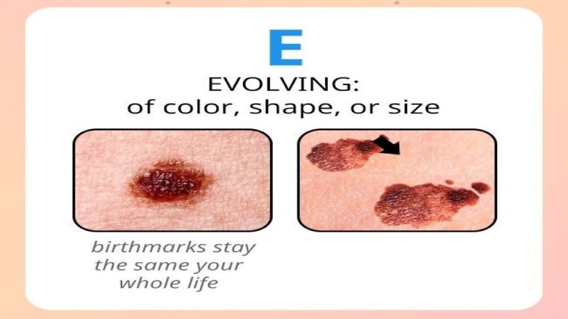 Σημάδι καρκίνου η εξέλιξη μεγέθους, χρώματος