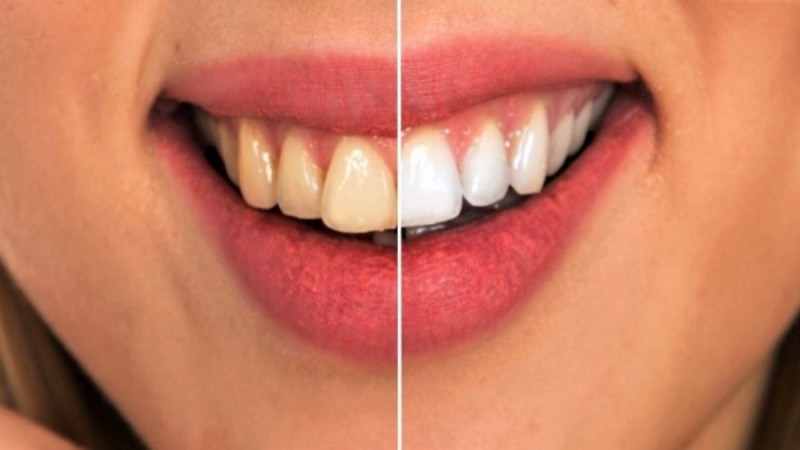 Τερηδόνα: Πώς θα την εξαφανίσετε τελείως και θα αποκτήσετε υγιή και γερά δόντια