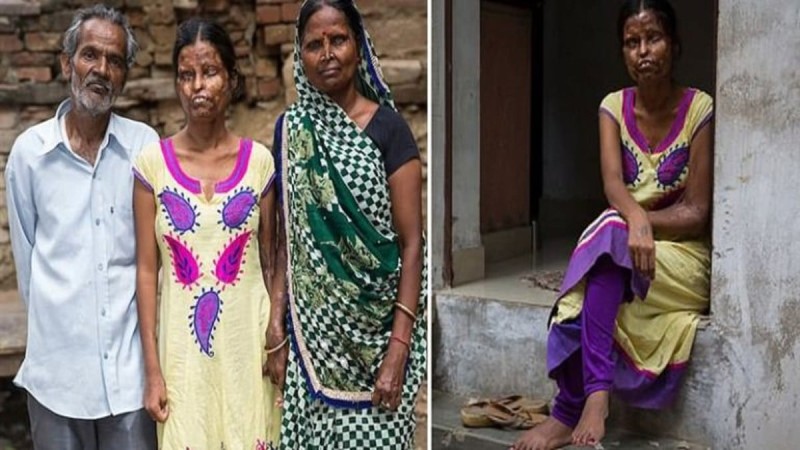Φρίκη - Τραγικό: Μητέρα και κόρη συνεχίζουν να ζουν με τον άνδρα που τις παραμόρφωσε με οξύ, λόγω φτώχειας (photos)