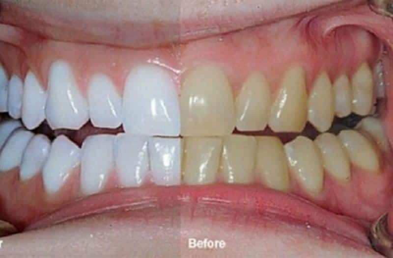 Λευκά δόντια αλουμινόχαρτο