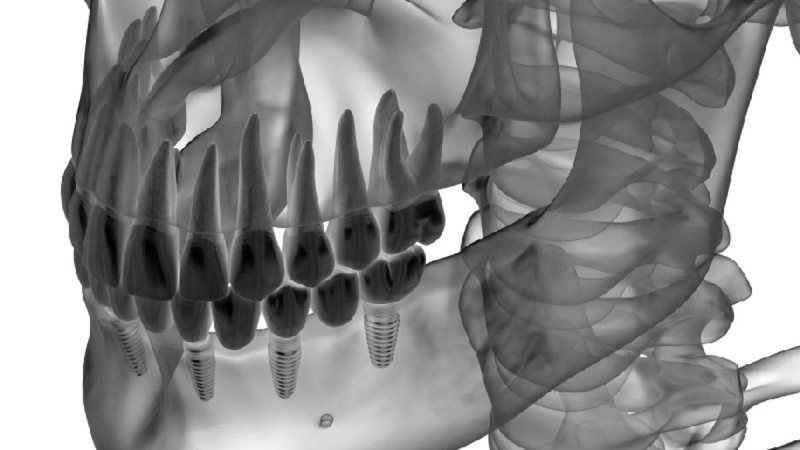 Όλα όσα θα πρέπει να γνωρίζετε για τα οδοντικά εμφυτεύματα