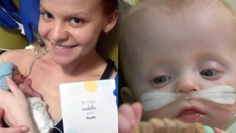 Μικρός ήρωας: Πρόωρο μωρό 23 εβδομάδων έδωσε μάχη και επέζησε μετά από 8 χειρουργεία