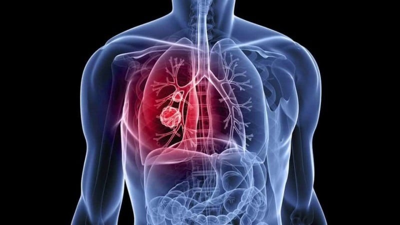 Το 90% των κυττάρων του καρκίνου του πνεύμονα καταστρέφεται από αυτή τη φυτική ουσία - Θα πάθετε σοκ