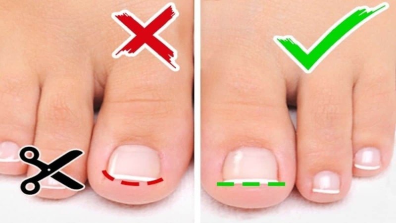 Αν κόβετε λάθος τα νύχια των ποδιών σας μπορεί να προκληθεί...: Μεγάλος κίνδυνος!
