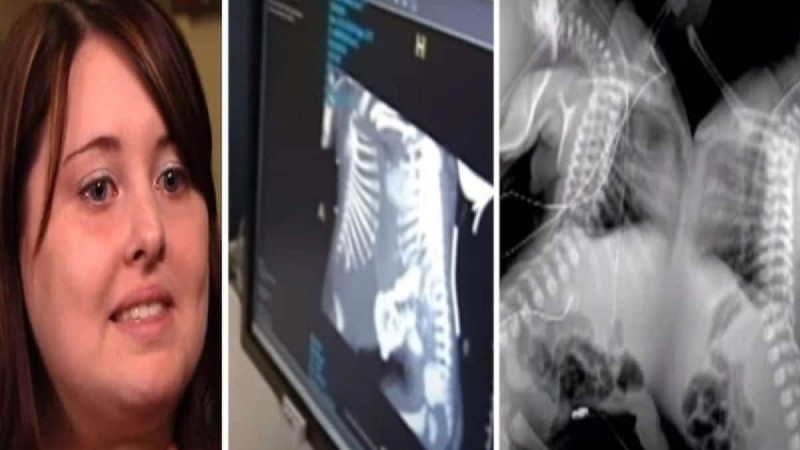 27χρονη έγκυος πήγε να κάνει υπερηχογράφημα - Όταν το είδαν οι γιατροί πάγωσαν και της είπαν να το ρίξει (Video)
