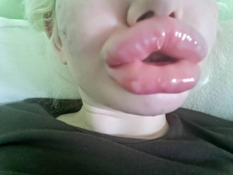 22χρονη ήθελε να αποκτήσει τα μεγαλύτερα χείλη του κόσμου. Το αποτέλεσμα είναι τρομακτικό