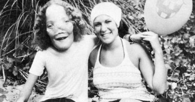 Δε πίστευαν οτι θα ζήσει, τον αντιμετώπιζαν ως «τέρας»: H απίστευτη ιστορία του αγοριού που έπασχε απο την ασθένεια της μάσκας