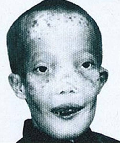 Δε πίστευαν οτι θα ζήσει, τον αντιμετώπιζαν ως «τέρας»: H απίστευτη ιστορία του αγοριού που έπασχε απο την ασθένεια της μάσκας