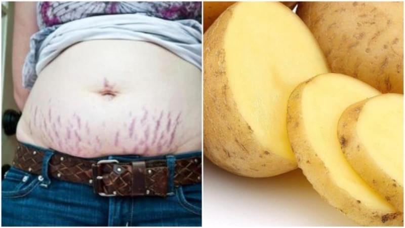 «Καλλυντικό» η πατάτα: Το μυστικό ομορφιάς που θα σας βοηθήσει να απαλλαγείτε από τις ραγάδες μια και καλή