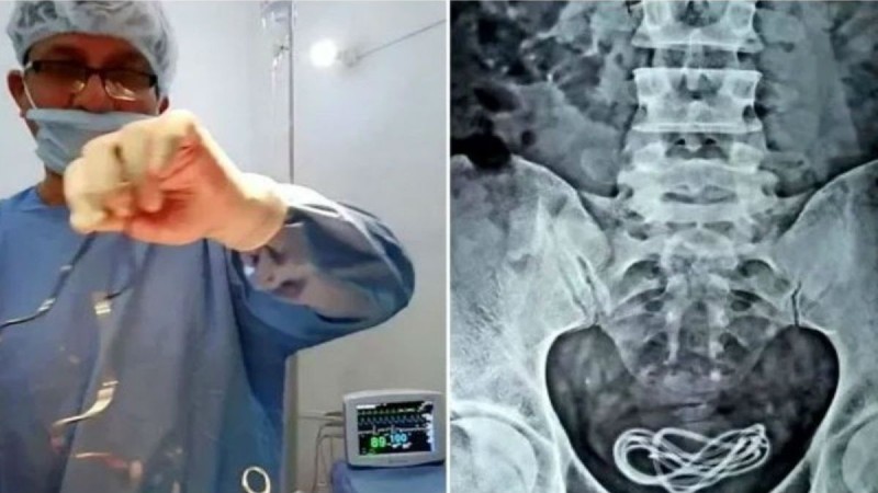 30χρονος πήγε στο νοσοκομείο με αφόρητους πόνους στην κοιλιά - Άφωνος ο γιατρός μόλις είδε την ακτινογραφία (photo)