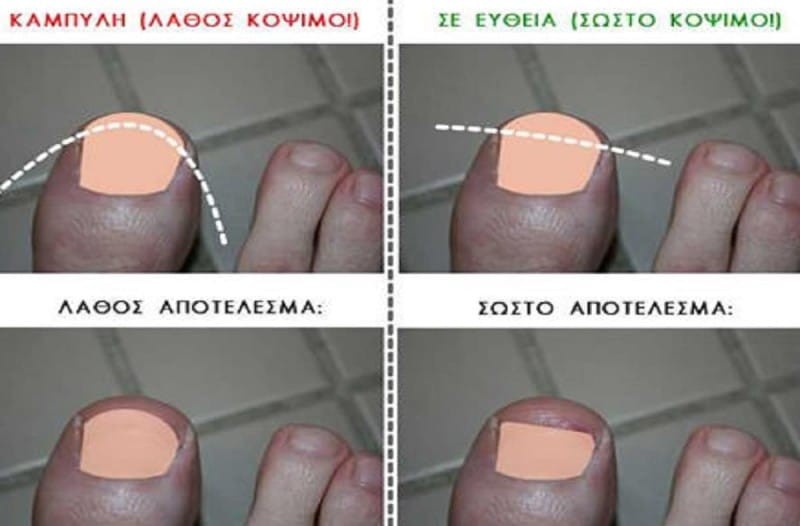 Μπαίνουν τα νύχια μέσα στο κρέας τον ποδιών σας; Δείτε τρόπους για να αποφύγετε το χειρουργείο!