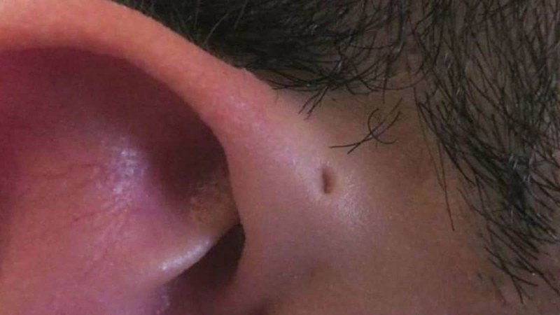 Έχετε δει αυτή την τρύπα στα αυτιά κάποιων ανθρώπων; Θα ανατριχιάσετε όταν διαβάσετε τι σημαίνει