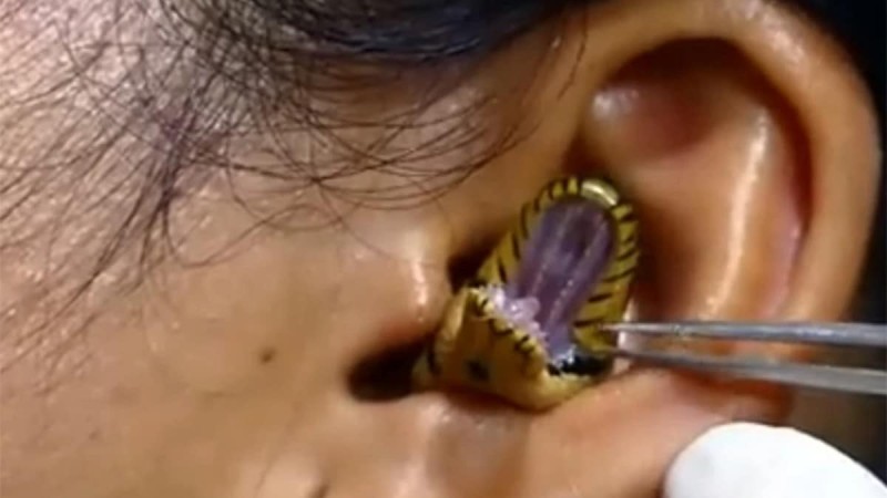 Ανατριχιαστικό βίντεο: Γιατρός παλεύει να αφαιρέσει ζωντανό φίδι από το αυτί μιας γυναίκας