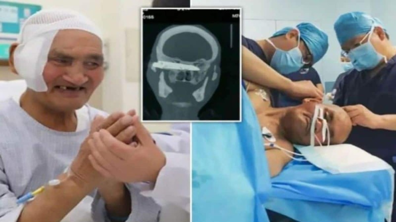 76χρονος παππούς πήγε στο νοσοκομείο γιατί πόναγε το κεφάλι του - Έπαθαν σοκ οι γιατροί με αυτό που είχε μέσα για... 8 χρόνια (photo)