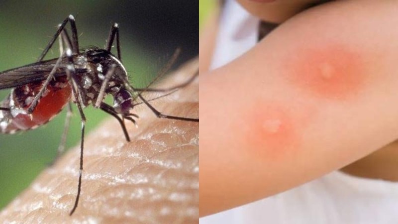 Ξεχάστε αλοιφές και «φιδάκια»: 5 δραστικά κόλπα για να «εξαφανίσετε» άμεσα το τσίμπημα του κουνουπιού