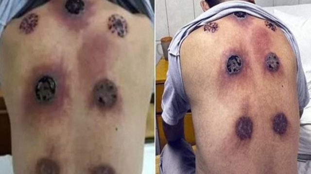 Η πλάτη του πρήστηκε και γέμισε τεράστιες τρύπες – Μόλις δείτε τι το προκάλεσε, θα ανατριχιάσετε!