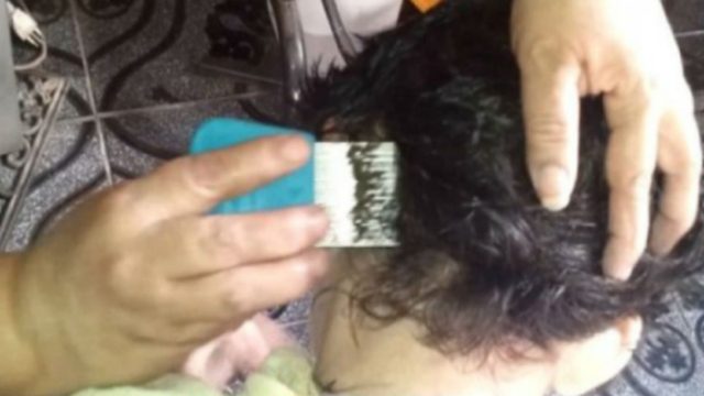 Ανατριχιαστικό video: Δείτε πόσες ψείρες έχει αυτό το κοριτσάκι στο κεφάλι της…
