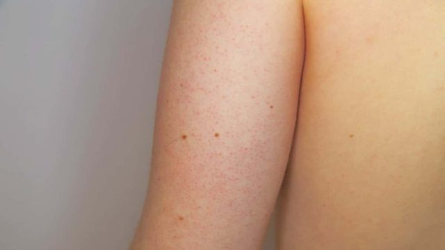 Μήπως βγάζετε κόκκινα σημαδάκια ή μικρά εξογκώματα στο πίσω μέρος των χεριών σας; Δεν φαντάζεστε τι είναι!