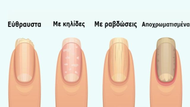 8 σημάδια στα νύχια που προειδοποιούν για σοβαρά προβλήματα υγείας