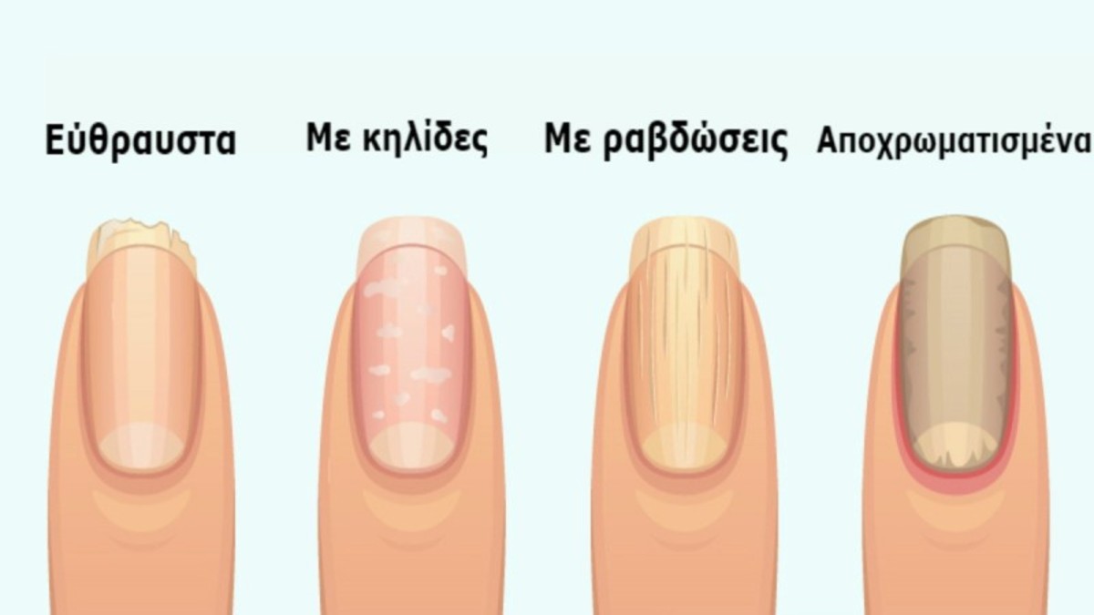 8 σημάδια στα νύχια που προειδοποιούν για σοβαρά προβλήματα υγείας