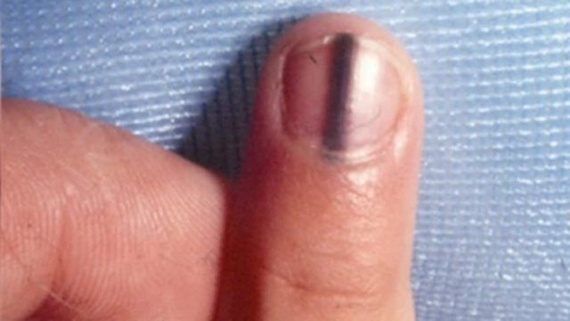Παρατήρησε μια μαύρη γραμμή μέσα στο νύχι της – Τότε ο γιατρός της αποκάλυψε ότι… (Video)