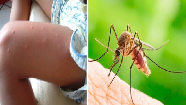 Κουνούπια: Τι πρέπει να τρώτε για να μην σας τσιμπάνε και φυσικοί τρόποι για να τα διώξετε