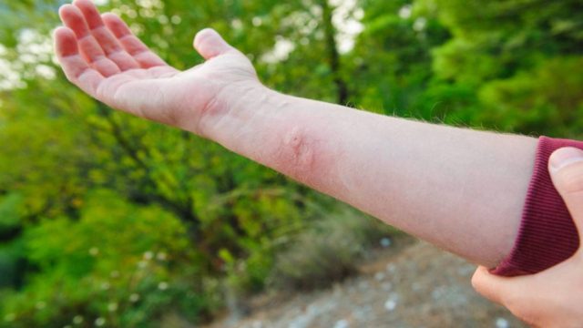 Κουνούπια: Η τροφή που καταναλώνεις και δεν σε τσιμπάνε – 10 τρόποι για να προφυλαχτείς