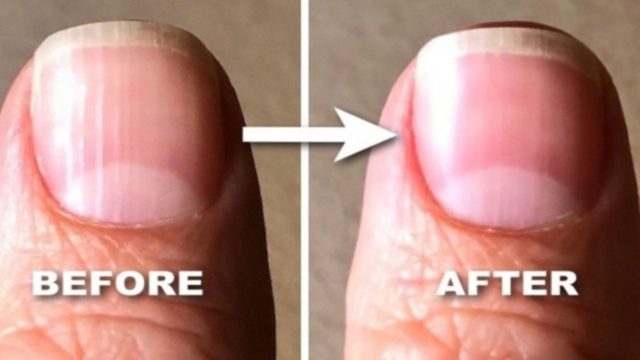 Γραμμές στα νύχια: Δείτε τι είναι και πώς μπορείτε να τις μειώσετε