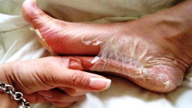 17 σοκαριστικά πράγματα που εύχεσαι να μην πάθεις ποτέ στα πόδια σου –  Το 4ο θα σε τρομάξει!