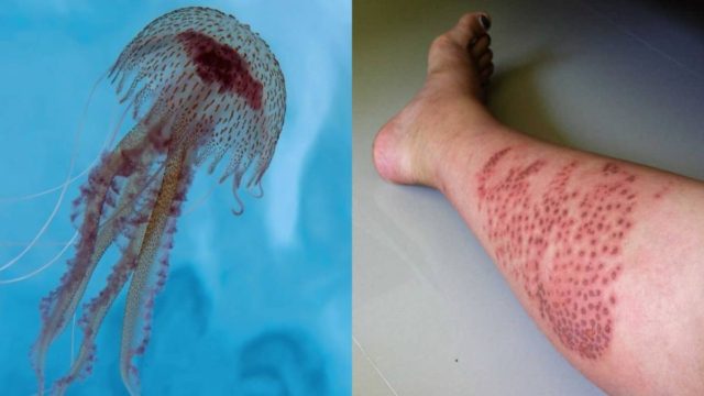 Τι πρέπει να κάνετε αν σας τσιμπήσει τσούχτρα – Ο «μύθος» που δεν πρέπει να πιστέψετε