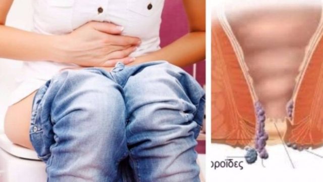 Κονδυλώματα πρωκτού: Αν έχετε αυτά τα συμπτώματα τρέξτε αμέσως στον γιατρό!