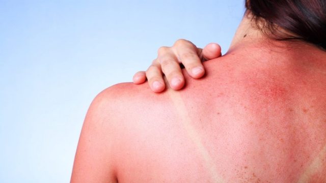 Κάψιμο από τον ήλιο: Πώς να το αντιμετωπίσουμε γρήγορα