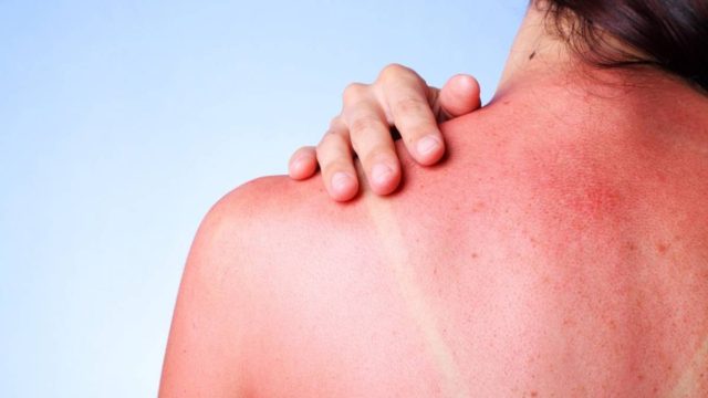 Κάηκε από τον ήλιο κι έκανε μπάνιο σε μαγειρική σόδα: Το αποτέλεσμα μοναδικό