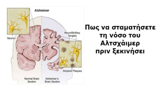 Η πρόληψη σώζει: 9+1 πράγματα που μπορείτε να κάνετε για να προλάβετε τη νόσο του Αλτσχάιμερ!