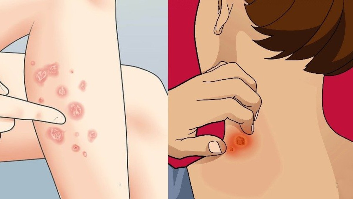 Νόσος Μπόουεν: Μοιάζει με σπυράκι αλλά είναι καρκίνος δέρματος – Πώς θα το καταλάβετε