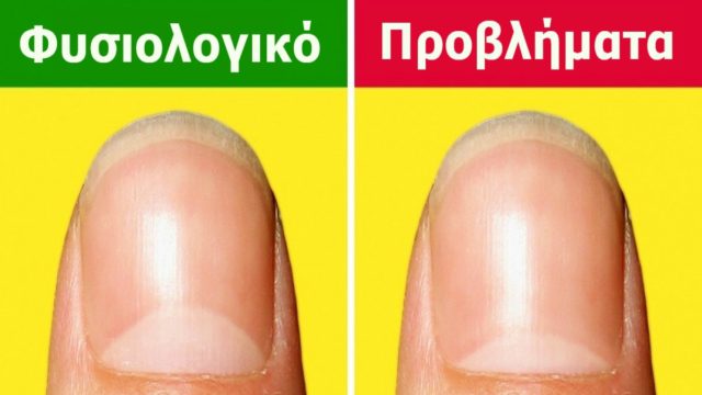 12+1 σημάδια στα νύχια που προειδοποιούν για σοβαρά προβλήματα υγείας