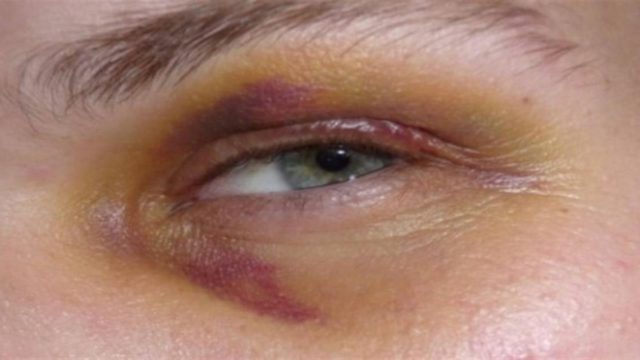 Το σαρδάμ και το μαυρισμένο μάτι: Το ανέκδοτο της ημέρας (16/9)