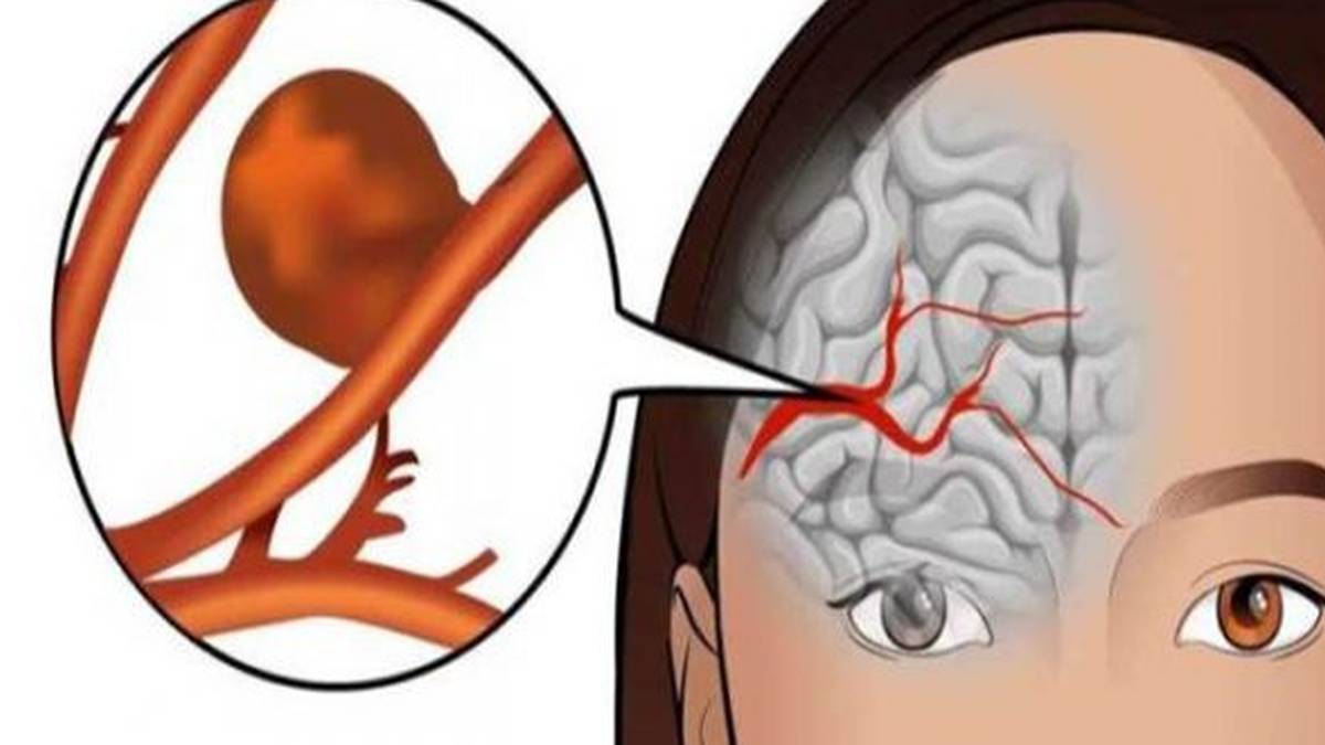 Ανεύρυσμα: 8 προειδοποιητικά σημάδια που δεν πρέπει ποτέ να αγνοήσετε