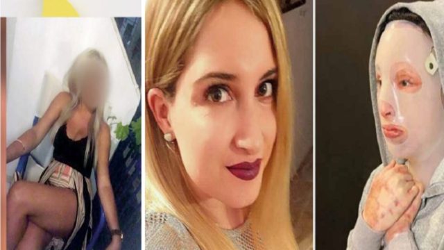 Επίθεση με βιτριόλι: «Το πρόσωπο της Ιωάννας δεν θα είναι ποτέ…» – Ανατριχιάζει η γιατρός της (Video)