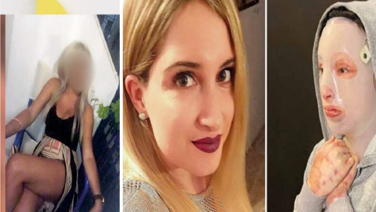 Επίθεση με βιτριόλι: «Το πρόσωπο της Ιωάννας δεν θα είναι ποτέ…» – Ανατριχιάζει η γιατρός της (Video)